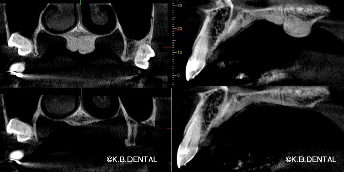 口蓋隆起形成術＋親知らず抜歯