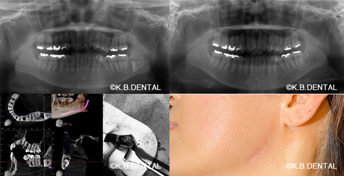 埋伏抜歯＋顎骨腫瘍摘出術