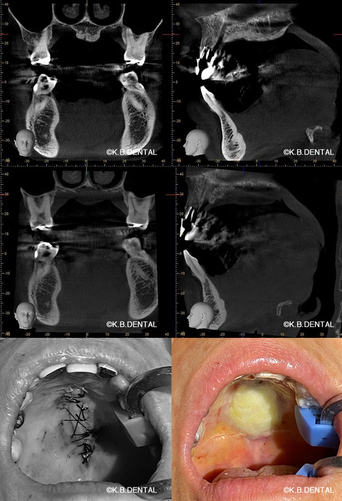 口蓋隆起形成術