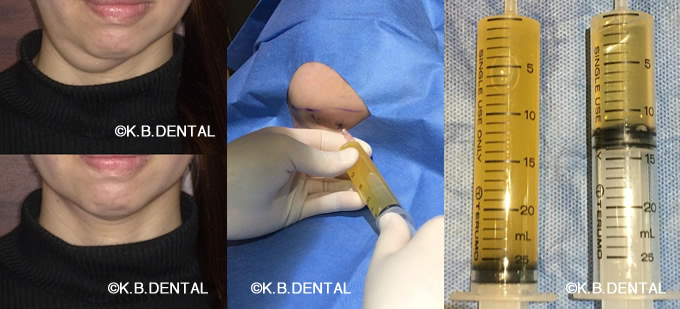 顎下型ガマ腫女性