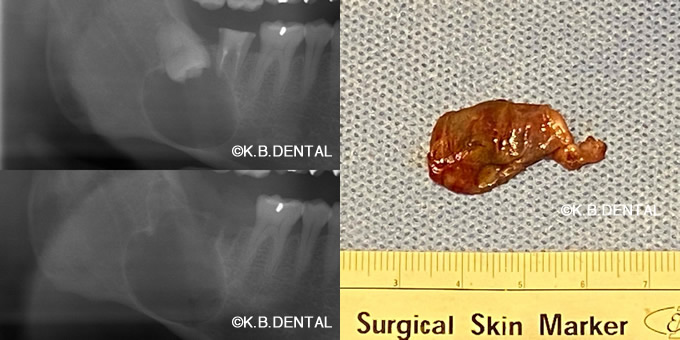 埋伏親知らず抜歯＋含歯性嚢胞摘出術