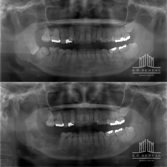セメント質骨形成線維種