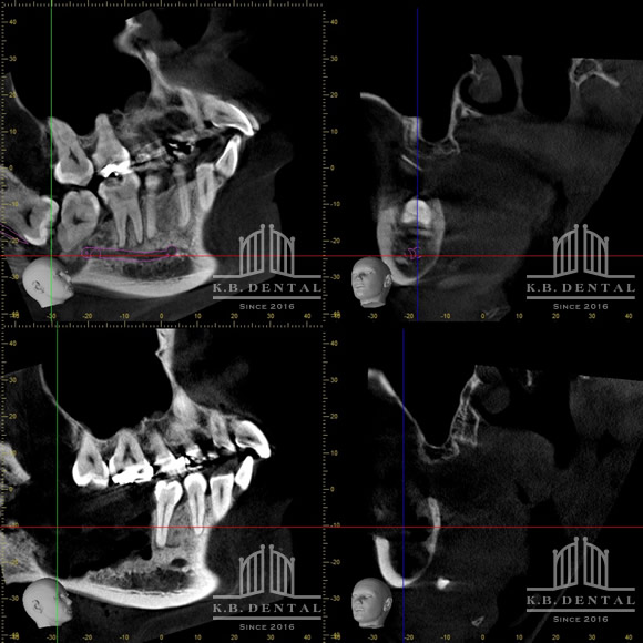 セメント質骨形成線維種