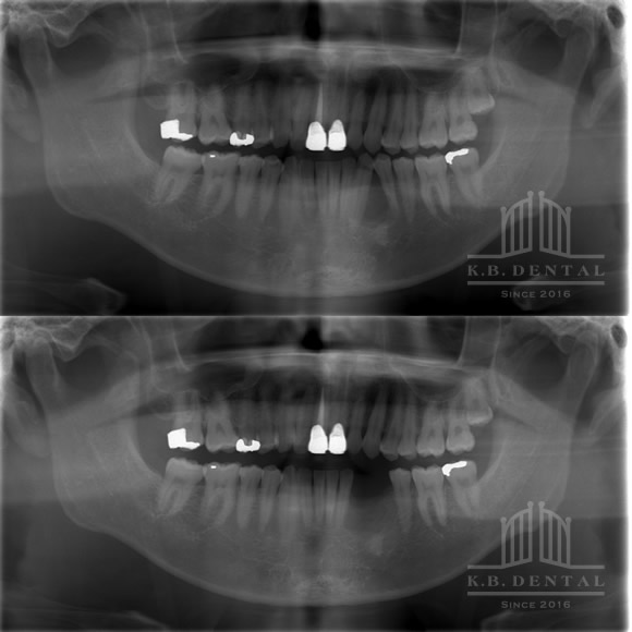 エナメル上皮腫