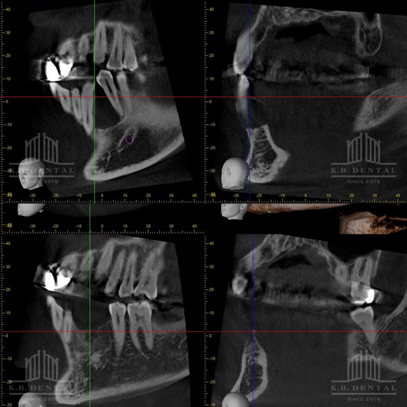 エナメル上皮腫