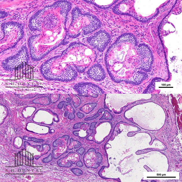 エナメル上皮腫