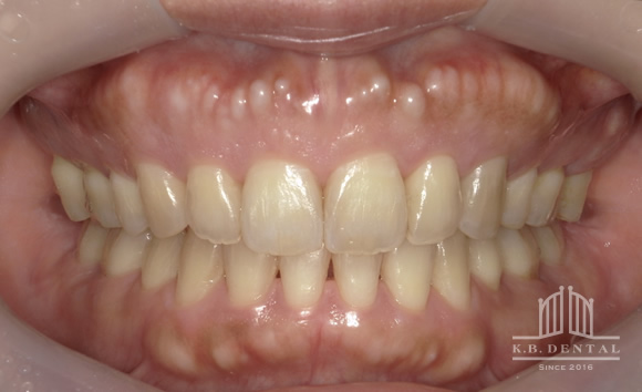 顎の頬側にできた骨隆起