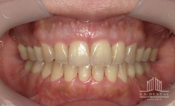 顎の頬側にできた骨隆起