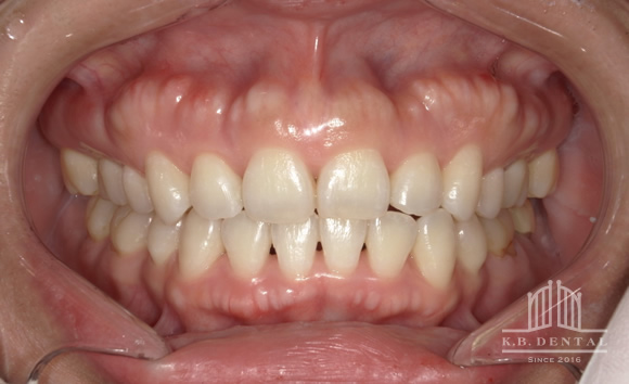 顎の頬側にできた骨隆起