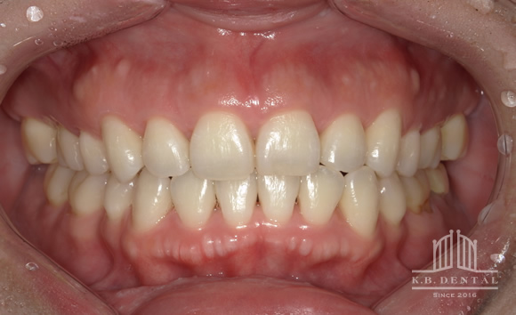 顎の頬側にできた骨隆起