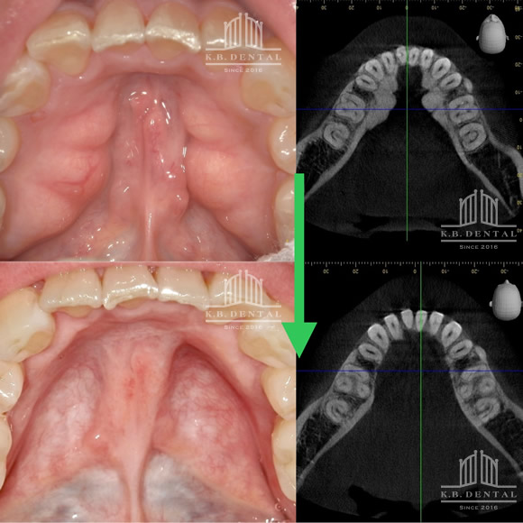 下顎舌側両側骨隆起除去