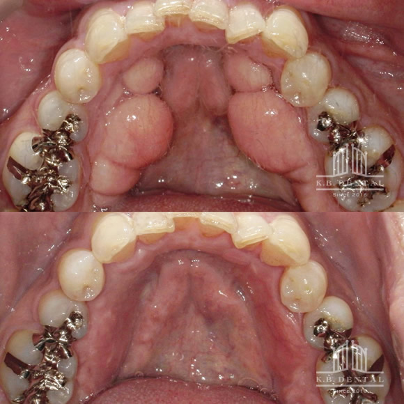 下顎舌側両側骨隆起除去