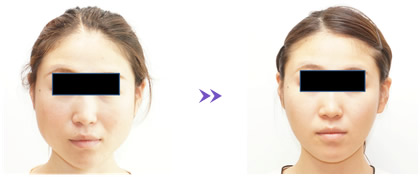 小顔のビフォーアフター