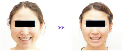 笑顔の術前・術後