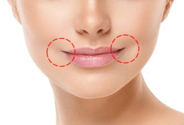 口角挙上ボツリヌストキシン