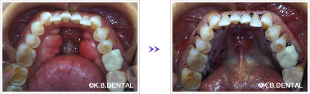 下顎骨隆起除去術前術後