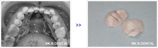 下顎骨隆起除去後の骨
