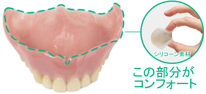 コンフォートデンチャー