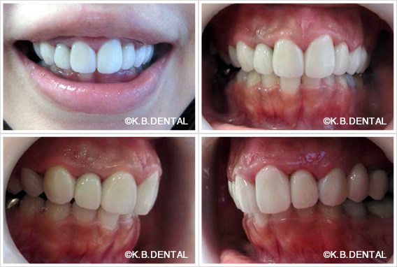 ジルコニア矯正