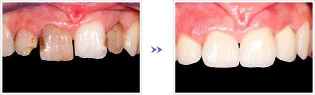 歯がボロボロを治した例