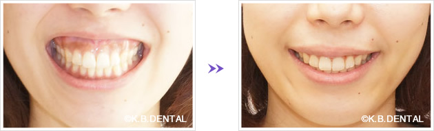 2センチのガミースマイル