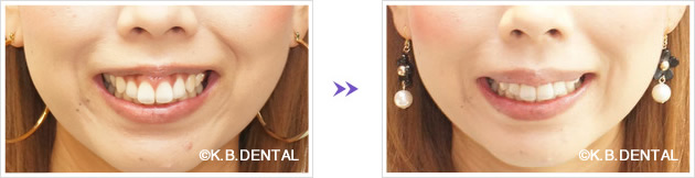 目立つガミースマイル