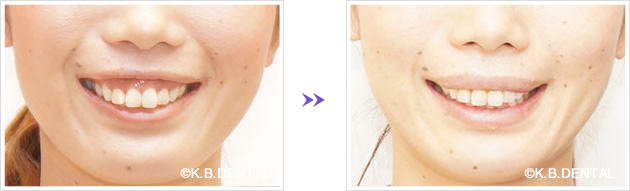 八重歯間のガミースマイル