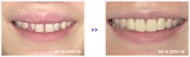歯冠延長術法によるガミースマイル