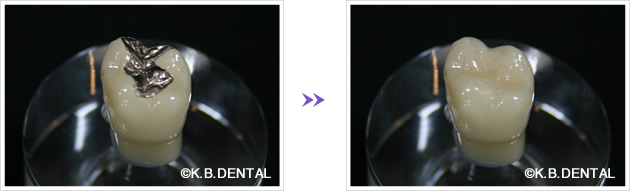 セラミックインレーのイメージ