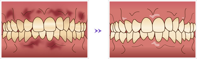ガムピーリング