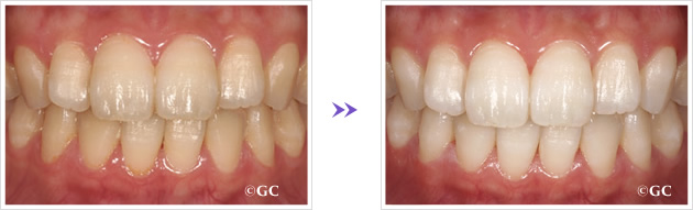ホワイトニング術前術後