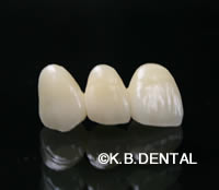 ジルコニア矯正