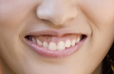 ガミースマイル