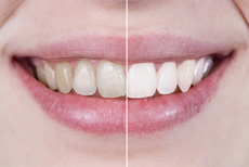 歯を白くしたい