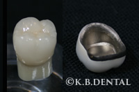 メタルボンドクラウン