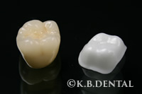 ジルコニアクラウン