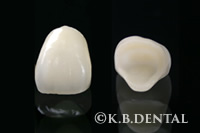 フルジルコニアクラウン