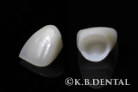 ジルコニアクラウン