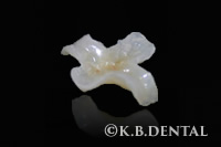 ハイブリッドインレー