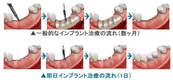 即日インプラント