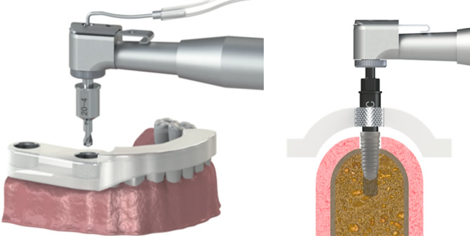 ガイドサージェリー