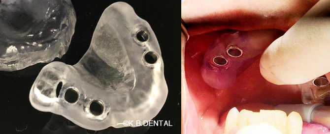 ガイドサージェリー