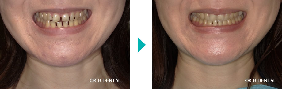 顔貌：すきっ歯治療例