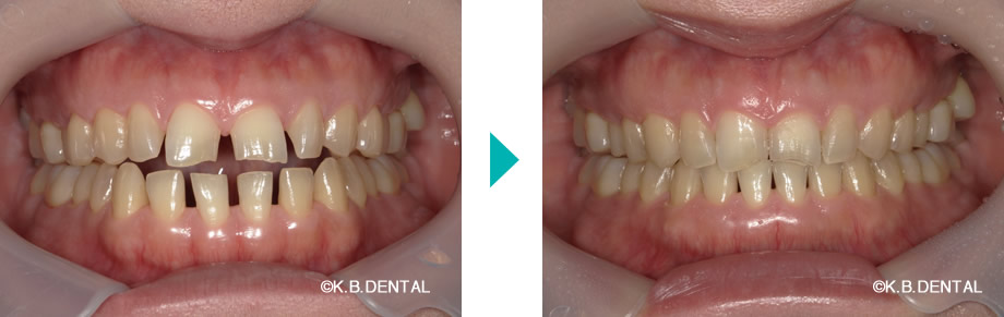 正面：すきっ歯治療例