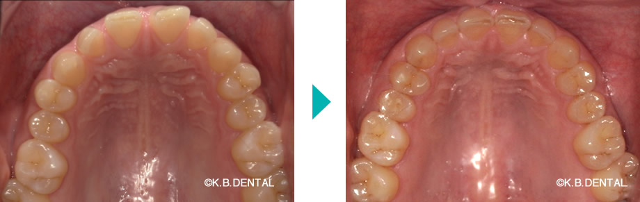 上顎：すきっ歯治療例