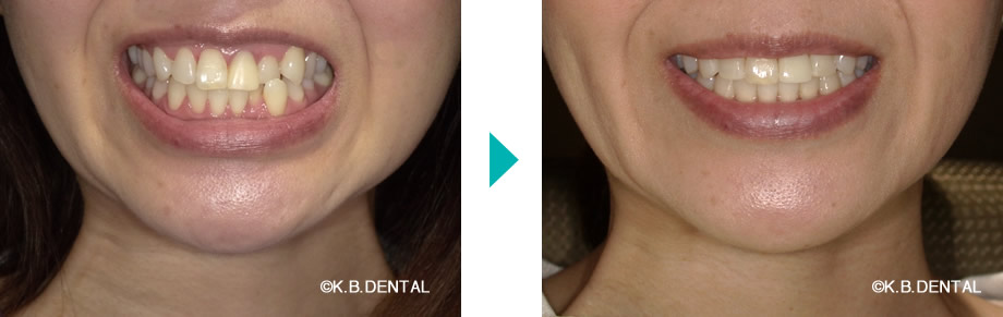 顔貌：叢生治療例