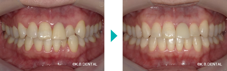 正面：叢生治療例