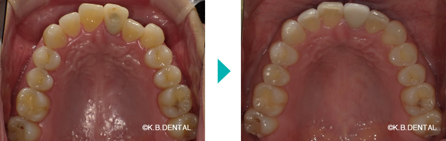 上顎：叢生治療例