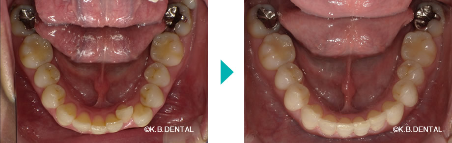 下顎：叢生治療例