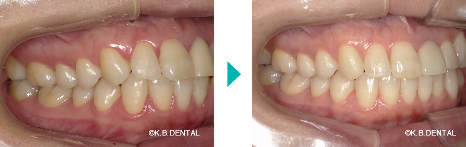 右側：叢生治療例